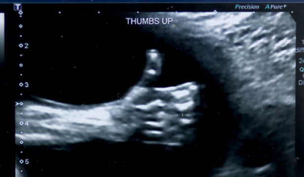 Thumbs Up Ultrasound