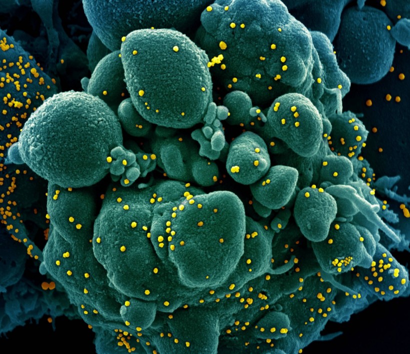 Colorized scanning electron micrograph of apoptotic cell infected with novel coronavirus