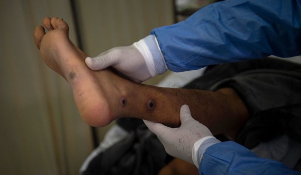 US Reports Its First Monkeypox-Related Death in Texas in Immunocompromised Adult