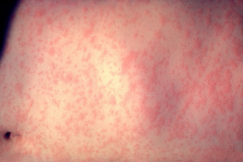 UK Measles Outbreak: UKHSA Declares National Health Incident as Cases Surge! What Should Parents Do?