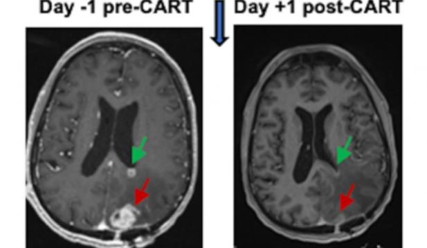 CAR-T Therapy-Brain Tumor