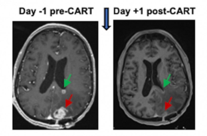CAR-T Therapy-Brain Tumor