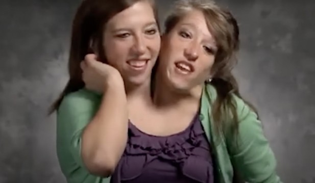 Conjoined Twins Abby & Brittany Hensel