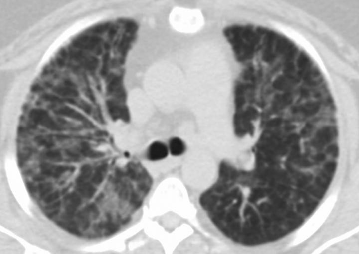 Giant Cell Interstitial Pneumonia Attributed to Vaping in 49 YO Woman (IMAGE)