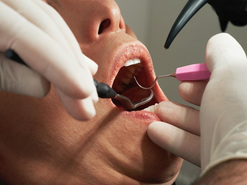 Debunking Myths about Dental Implants